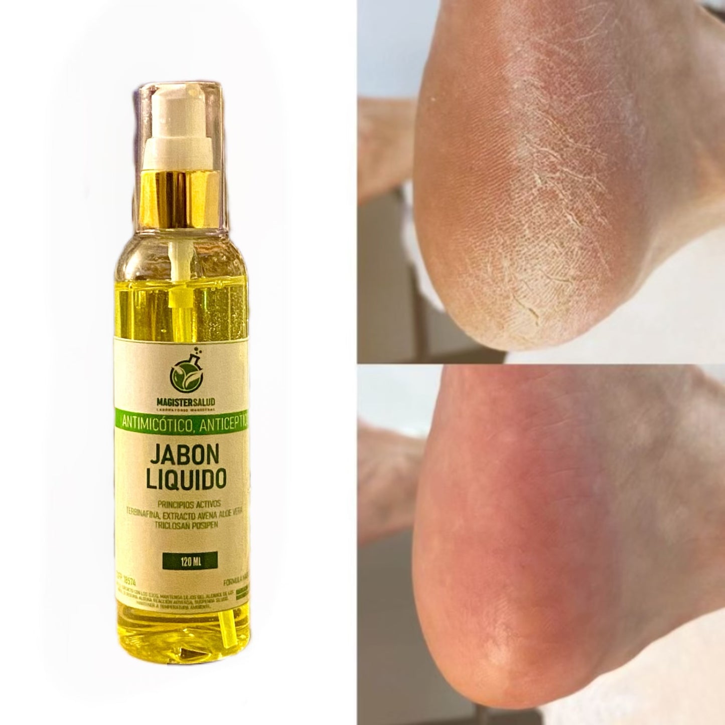 JABÓN LÍQUIDO ANTIMICÓTICO (ELIMINA LOS HONGOS DE RAIZ)